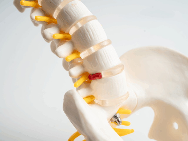 繰り返す腰痛の正体？椎間板ヘルニアの根本改善ガイド